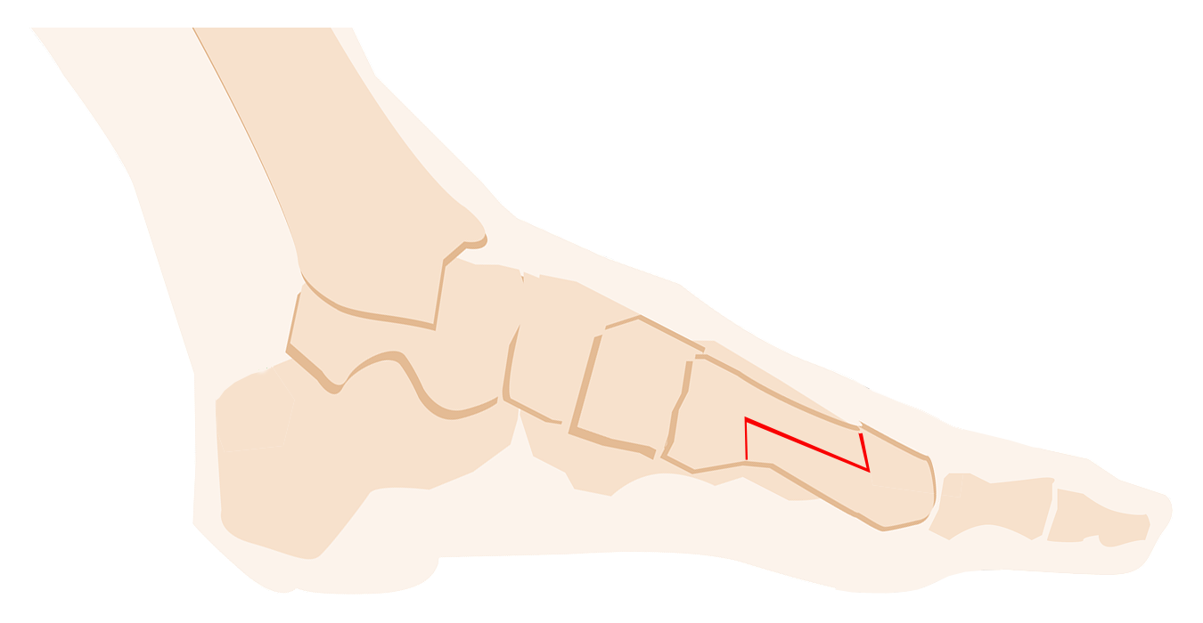 Hallux valgus Salzburg Dr. Planitzer