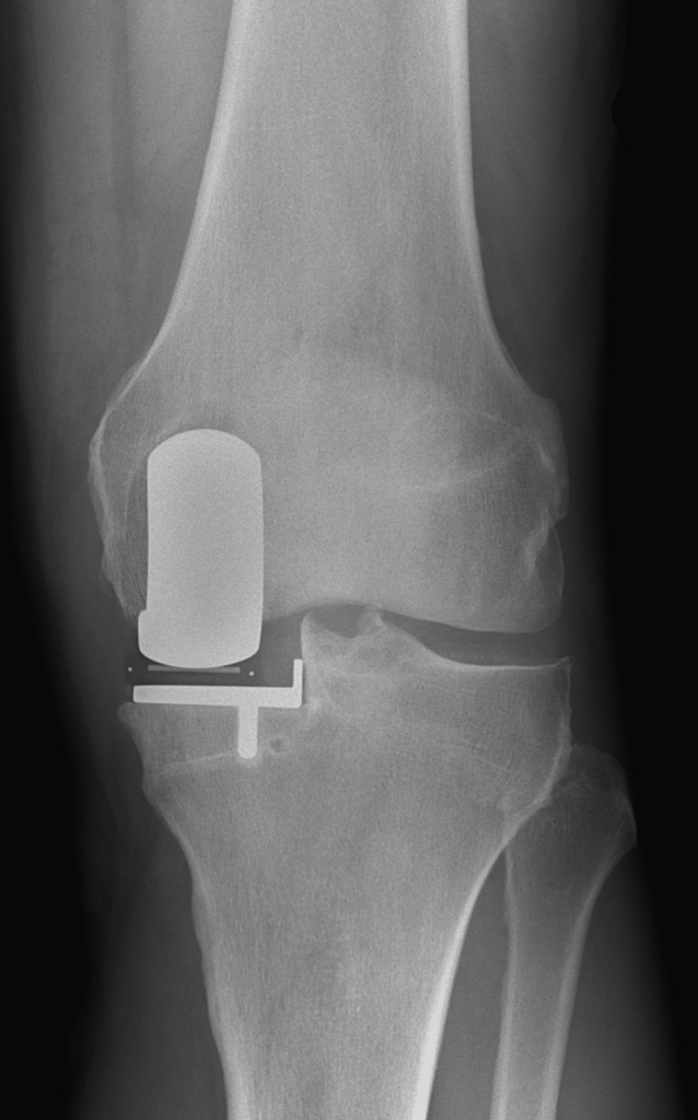Röntgen Halbschlittenprothese Dr. Planitzer
