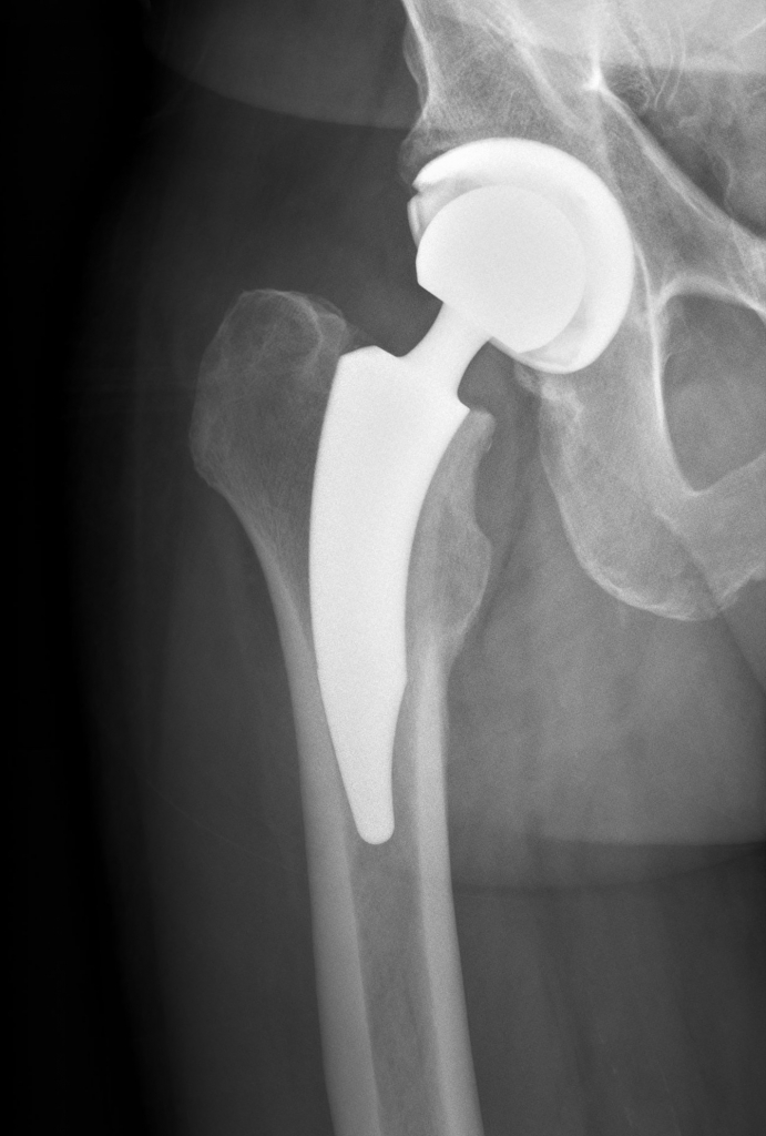 Hüftprothese Orthopäde Salzburg Dr. Planitzer