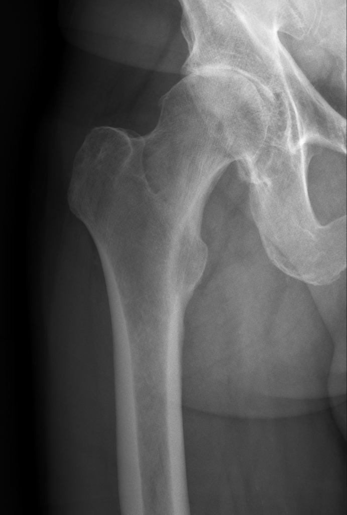 Arthrose Hüfte Orthopäde Salzburg Dr. Planitzer