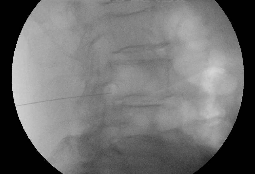 Nervenwurzelinfitration Orthopäde Salzburg