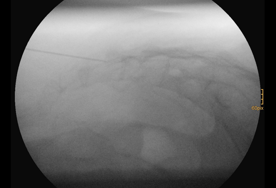 sakralblock Infiltration Wirbelsäue Orthopäde Salzburg