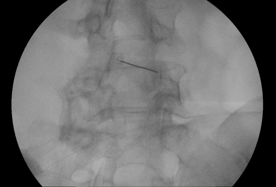 Röntgen Infiltration Wirbelsäule Orthopäde Salzburg